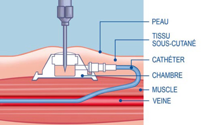 chimiotherapie